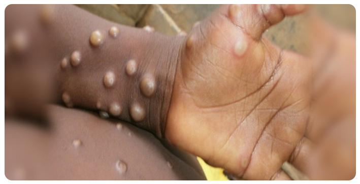 suspected-monkeypox-case-in-kerala-samples-of-traveller-from-uae-sent-