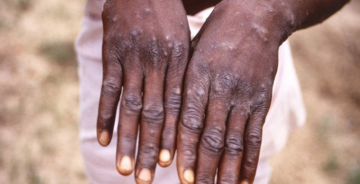 Monkeypox Cases Rise in Europe and North America, Govt Asks NCDC, ICMR to Keep Close Watch
