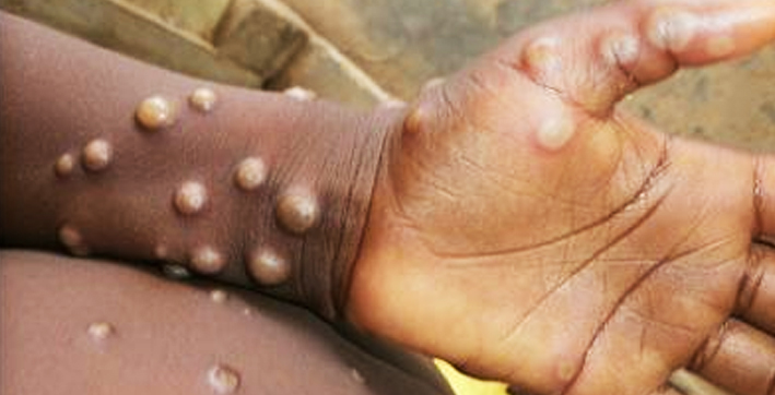 Amid Increasing Monkeypox Cases in Non-Endemic Countries, Centre To release Guidelines Soon