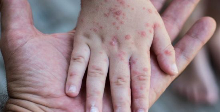 Monkeypox Outbreak: Children More At Risk Says ICMR
