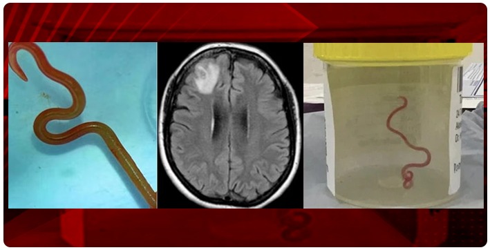 australian-doctor-discovers-live-parasitic-worm-in-womans-brain