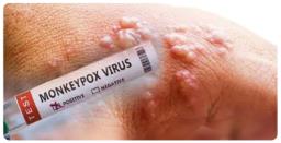 Delhi Reports Its 5th Monkeypox Case, India Its 10th 